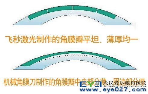 飞秒激光制作角膜瓣