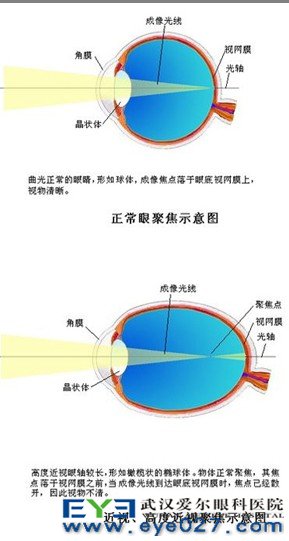 近视到底是什么原理_什么是近视(2)