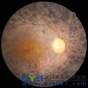 视网膜色素变性特殊症状