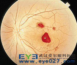 眼底出血的原因