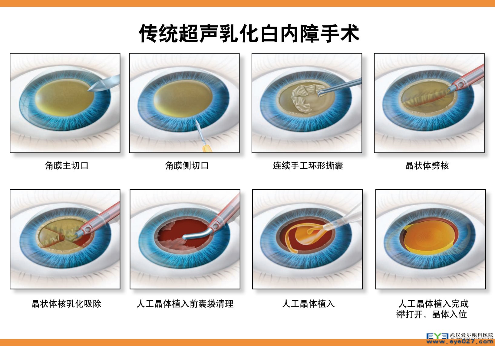 飞秒激光白内障手术PK传统超声乳化白内障