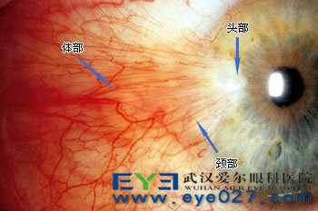 预防翼状胬肉