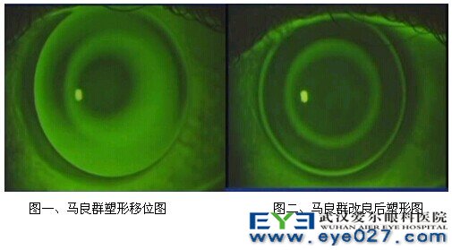 角膜塑形移位图