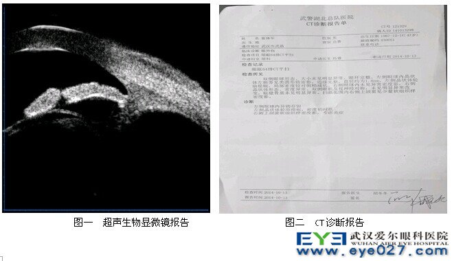 超声生物显微镜报告