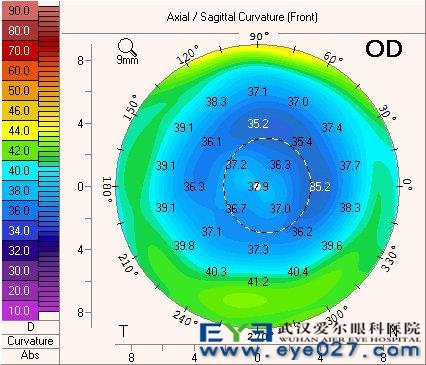术后角膜地形图