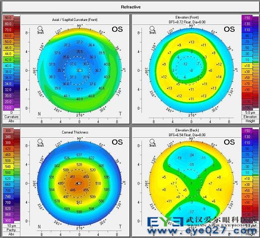 角膜地形图