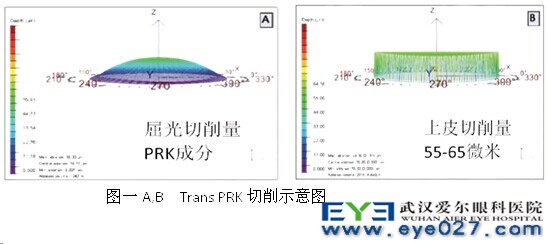 Trans PRK切削示意图