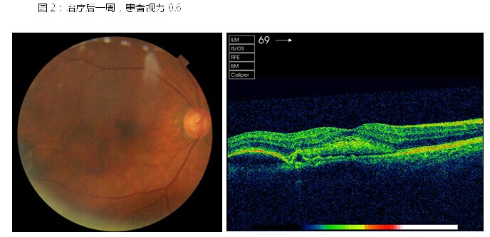 黄斑变性