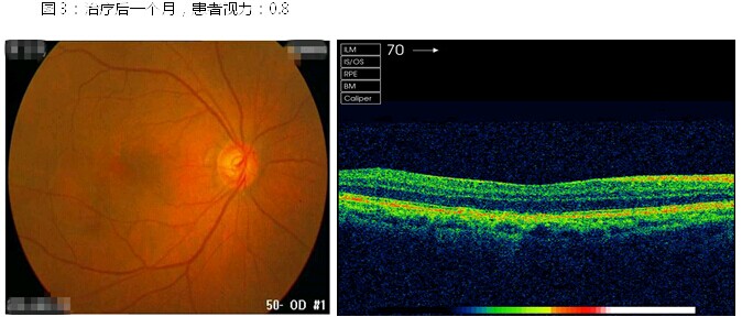 黄斑变性