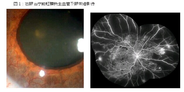 糖尿病致视网膜病变