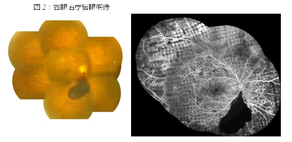 糖尿病致视网膜病变