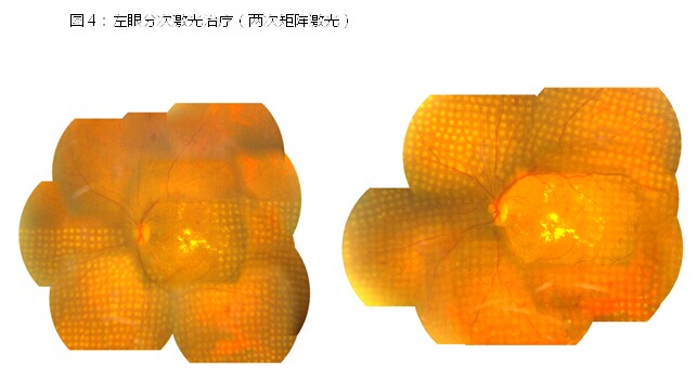 糖尿病致视网膜病变