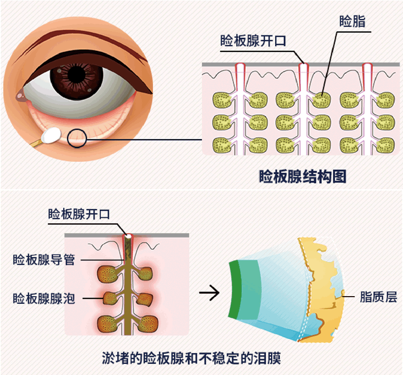 什么是睑板腺功能障碍